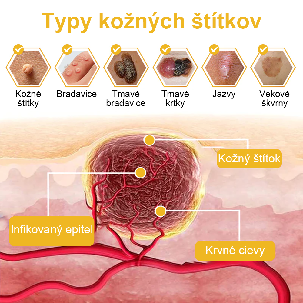 ✨🎁FROPUN krém na odstránenie znamienok a materských znamienok (posledný deň akcie 85% zľava)