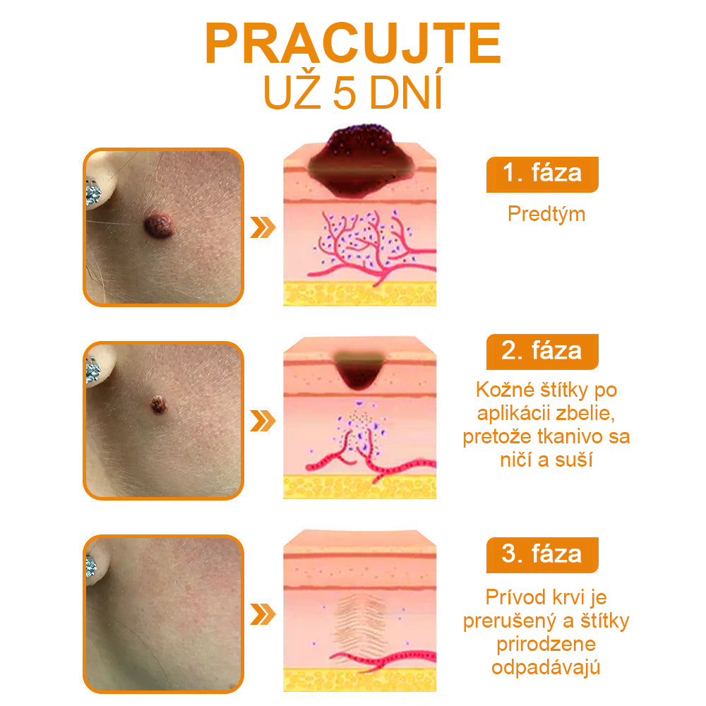 ✨BENETURE“ Krém na odstránenie bradavíc a znamienok zo včelieho jedu (posledný deň predaja, 80% zľava)