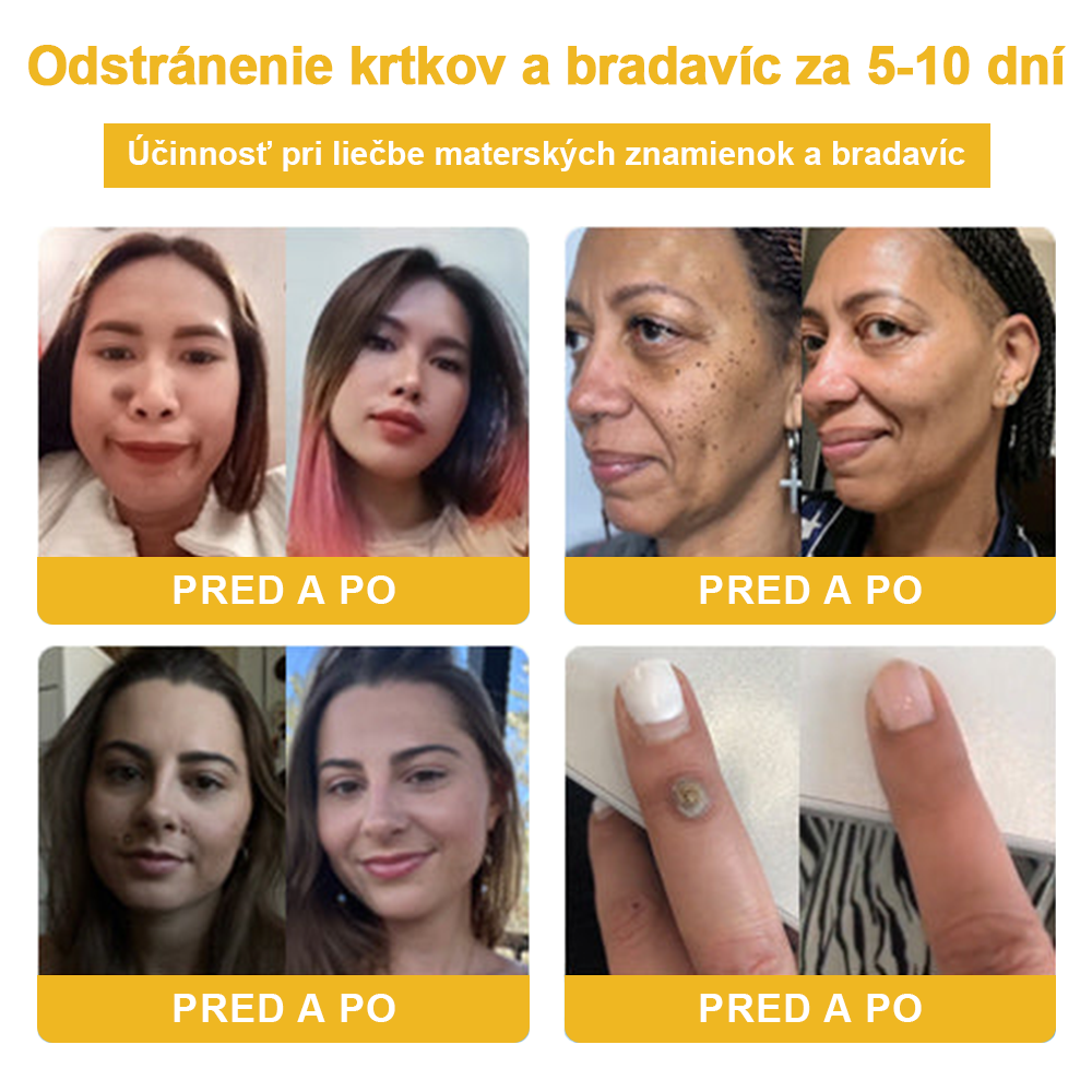 ✨🎁FROPUN krém na odstránenie znamienok a materských znamienok (posledný deň akcie 85% zľava)