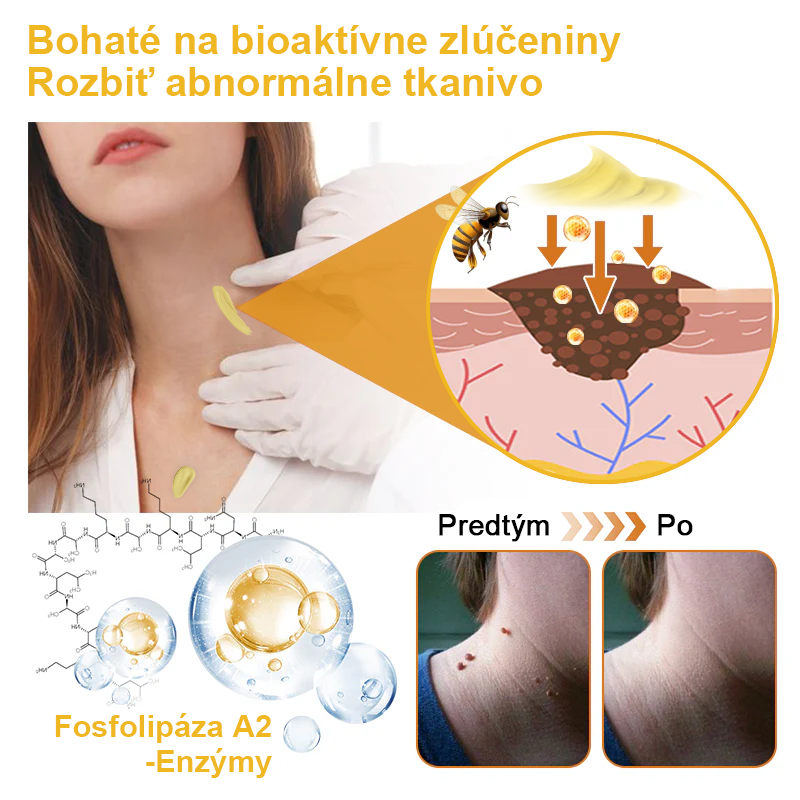 ✨🎁FROPUN krém na odstránenie znamienok a materských znamienok (posledný deň akcie 85% zľava)